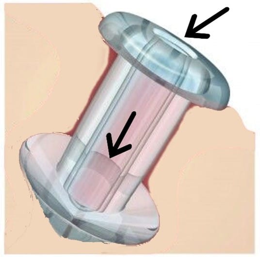 Η αντιμετώπιση της στένωσης ή και απόφραξης των δακρυϊκών σημείων γίνεται με δυο τρόπους: μη χειρουργικά με τοποθέτηση στο ιατρείο ειδικών βυσμάτων που κάνουν διαστολή του στενωμένου δακρυϊκού σημείου (flow controllers). Με αυτόν τον τρόπο φεύγει το δάκρυ διαμέσου του του δακρυϊκού αποχετευτικού συστήματος όπως φαίνεται και στην φωτογραφία. Μερικές φορές όμως, φεύγουν από την θέση τους και χρειάζεται να τοποθετηθούν νεα βύσματα